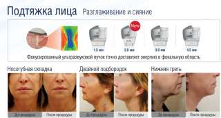 ПРОЦЕДУРА SMAS-лифтинга на ультразвуковом аппарате Hifu