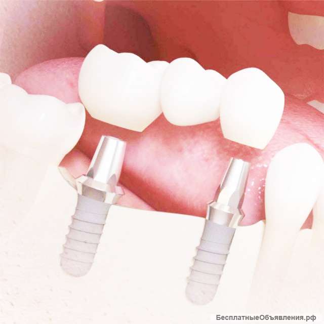 Импланты straumann