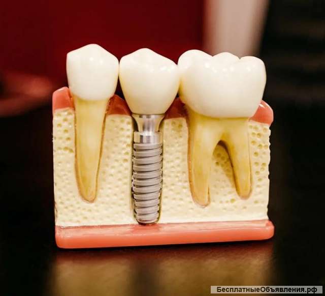 Установка виниров в москве