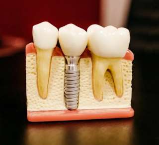 Установка виниров в москве