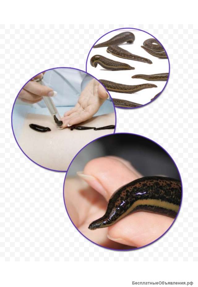 Гирудотерапия