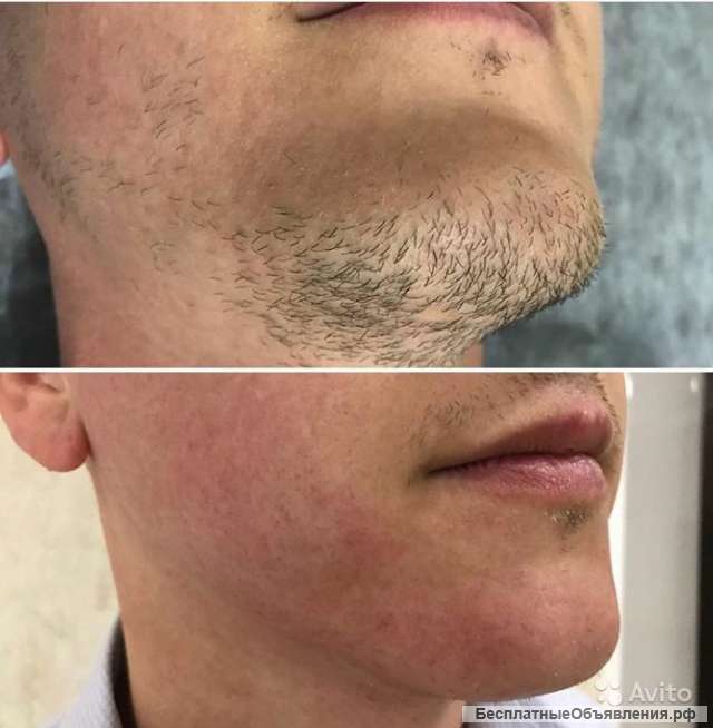 Лазерная эпиляция для мужчин