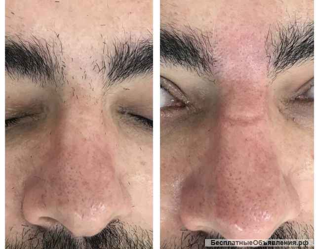 Лазерная эпиляция для мужчин