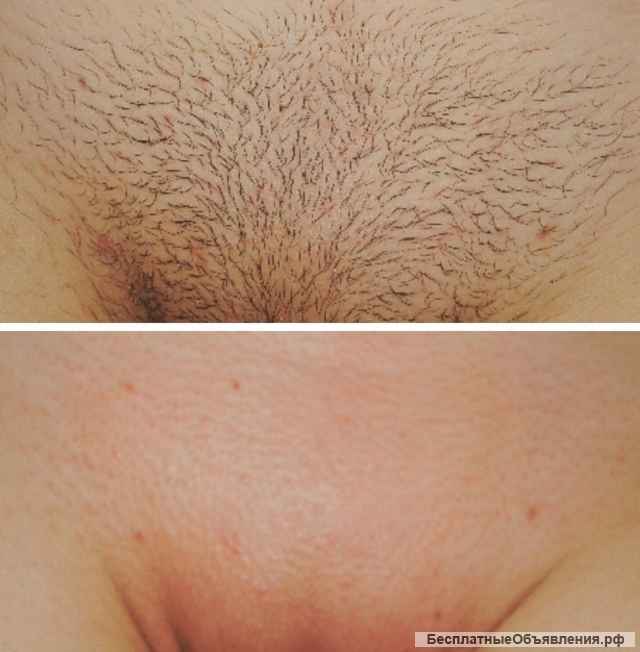 Лазерная эпиляция для мужчин