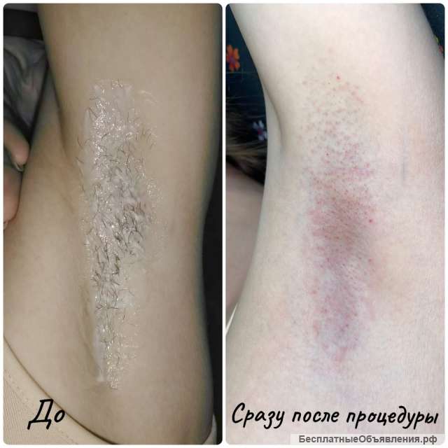 Электроэпиляция