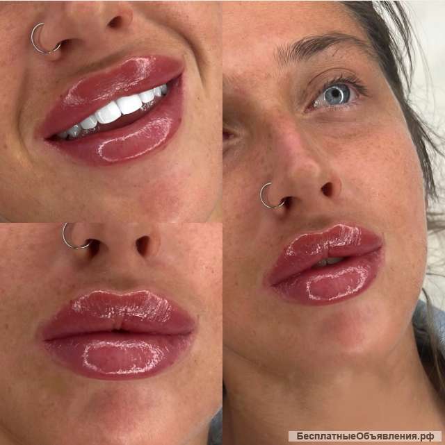 Легендарная пластика губ