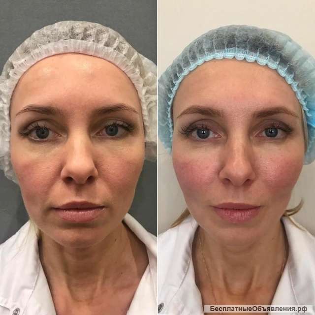 Модель на smas лифтинг