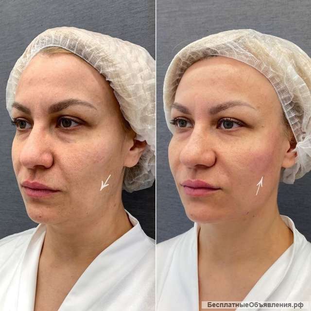 Модель на smas лифтинг