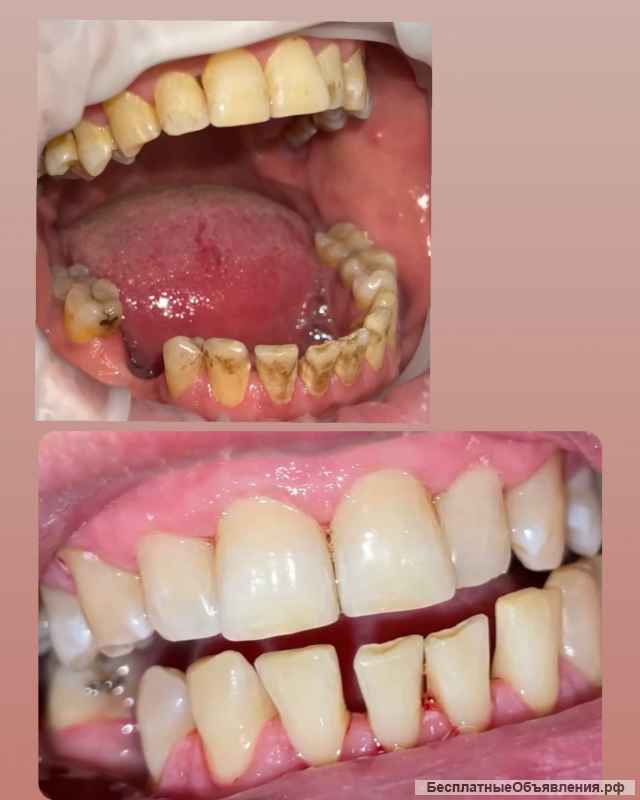 Профессиональная гигиена полости рта