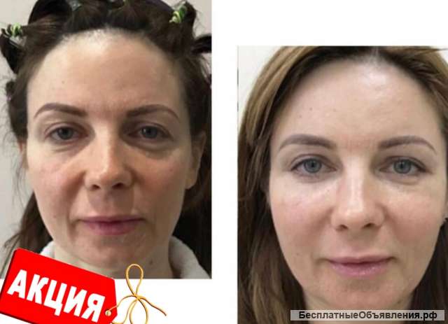 Приглашаем моделей на Смас-лифтинг Москва