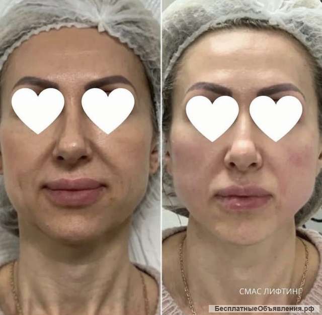 Приглашаем моделей на Смас-лифтинг Москва