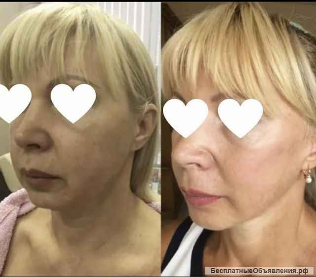 Приглашаем моделей на Смас-лифтинг Москва