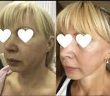 Приглашаем моделей на Смас-лифтинг Москва