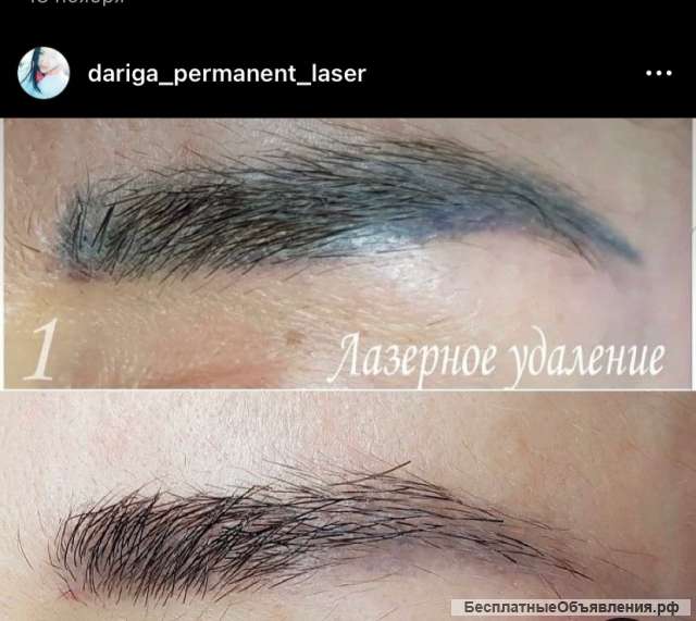 Удаление тату лазером, карбоновый пилинг