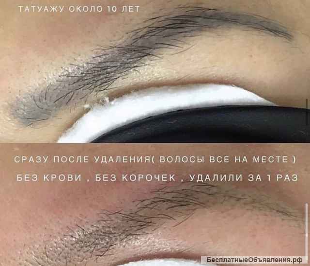Удаление тату лазером, карбоновый пилинг