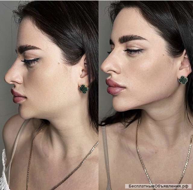 Акция Смас лифтинг