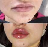 Акция Смас лифтинг