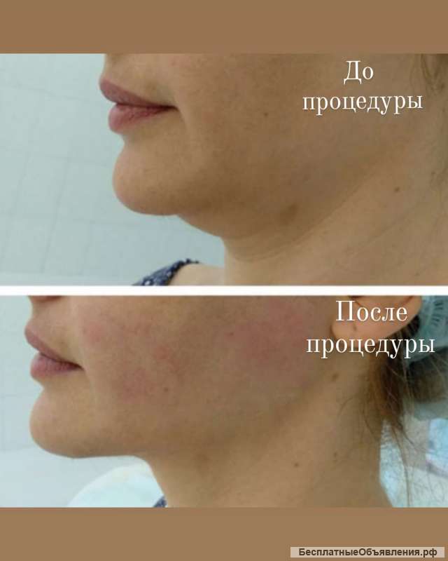 Смас лифтинг