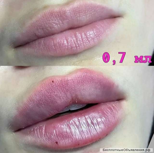 Увеличение губ