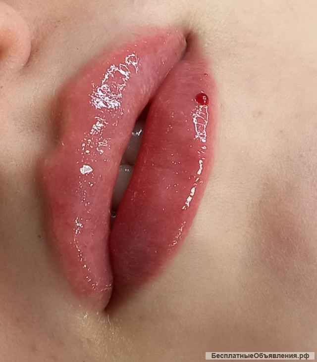 Увеличение губ