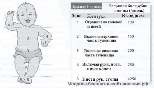 Аренда лампы для лечения желтухи у малышей на дому. Фототерапия КИШИНЕВ. + 37379070977.