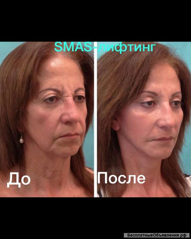 Модель на smas-лифтинг