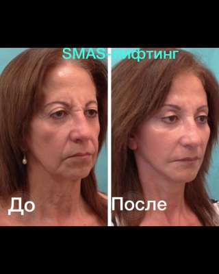 Модель на smas-лифтинг