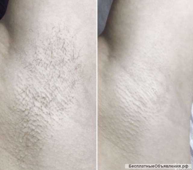 Шугаринг/ Отбеливание зубов