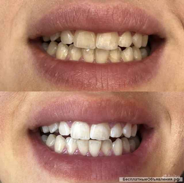 Шугаринг/ Отбеливание зубов