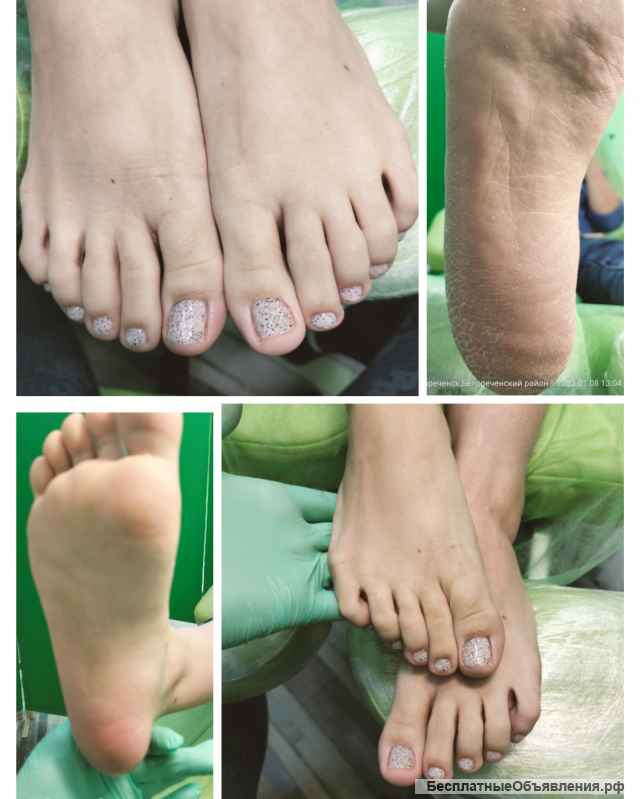 Аппаратный педикюр