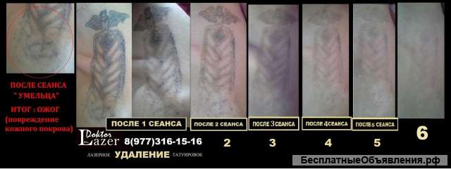 Лазерное удаление татуировок и татуажа в Клину