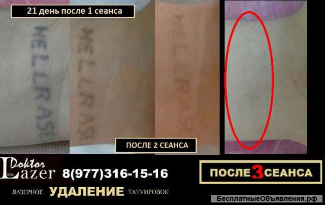 Лазерное удаление татуировок и татуажа в Клину
