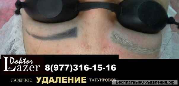 Лазерное удаление татуировок и татуажа в Клину