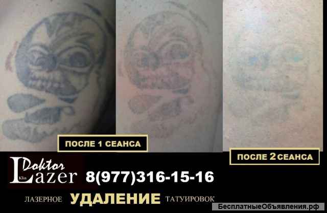Лазерное удаление татуировок и татуажа в Клину