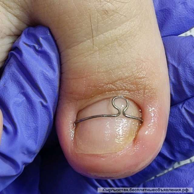 ПОДОЛОГ Бишкек. Вросшие Ногти @podolog_kg