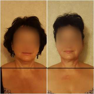 Остеопластика, миофосоциальный массаж