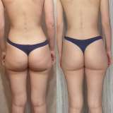 Остеопластика, миофосоциальный массаж