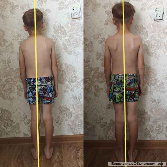 Остеопластика, миофосоциальный массаж