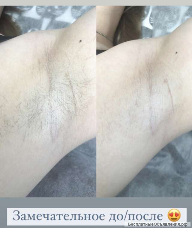 Депиляция воском