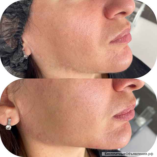 Контурная пластика, ботулинотерапия, биоревитализация