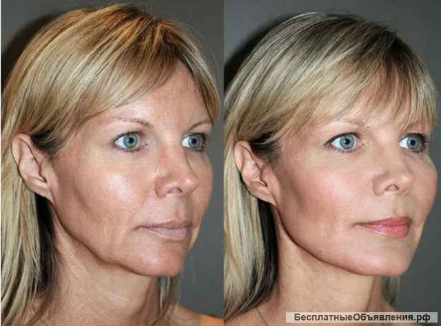 SMAS и RF лифтинг, Лазерная эпиляция, Кавитация, Вакуумный массаж