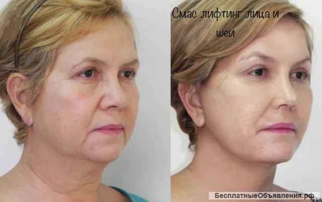 SMAS и RF лифтинг, Лазерная эпиляция, Кавитация, Вакуумный массаж