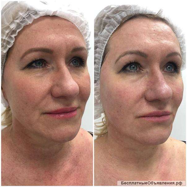 Смас - лифтинг