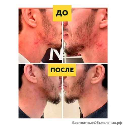 Освободите кожу от прыщей Silver Shein