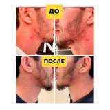 Освободите кожу от прыщей Silver Shein