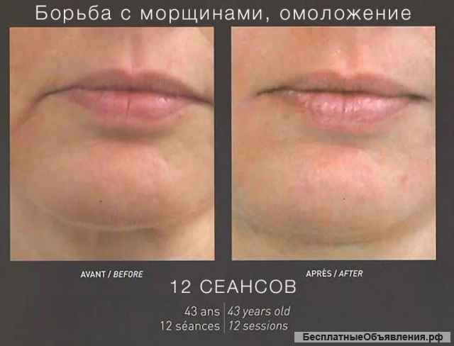 Абонементы: Лицо на процедуры LPG массажа. Франция
