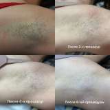 Лазерная эпиляция