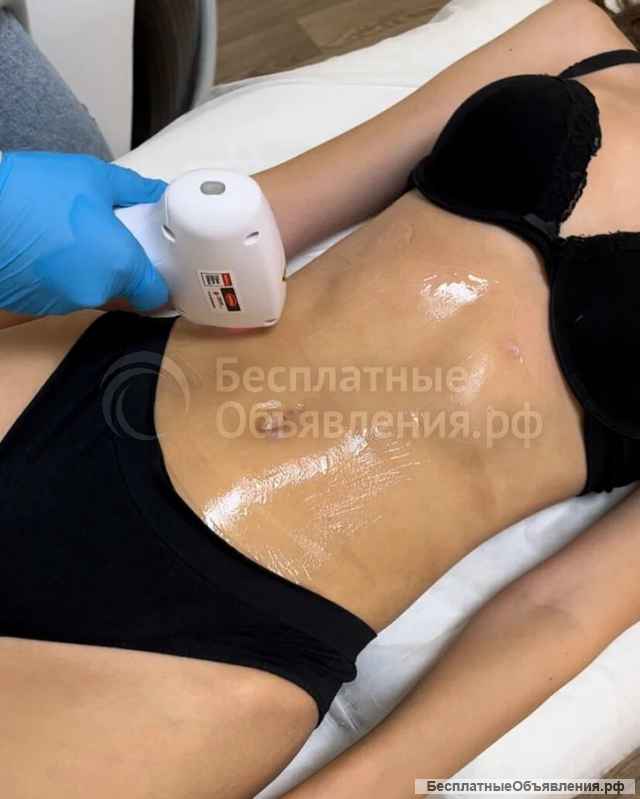Лазерная эпиляция