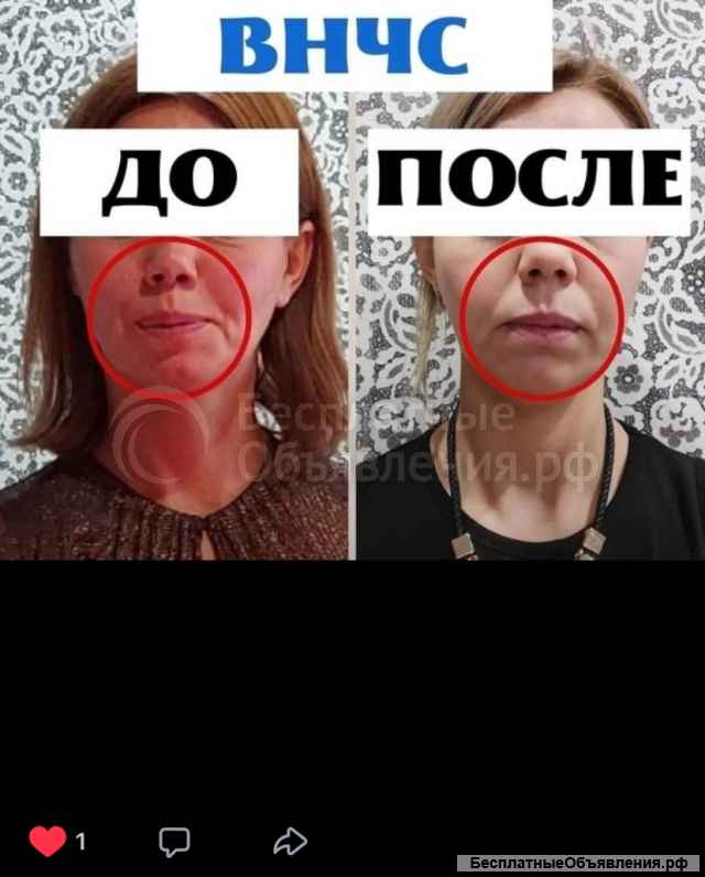 Антиспазм подзатылочных мышц