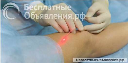 Эндовазальная лазерная коагуляция